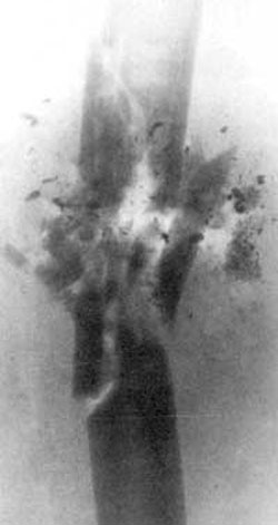 Рис 4. Рентгенограмма ранения бедра 5,56-мм пулей патрона М193. Огнестрельный многооскольчатый перелом бедренной кости. В области перелома -многочисленные осколки фрагментированной пули (дальность стрельбы - 10м).
