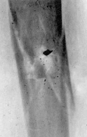 Рис 5. Рентгенограмма ранения бедра 5,45-мм пулей патрона 7Н6. Огнестрельный многооскольчатый перелом бедренной кости. В области перелома - характерный треугольный фрагмент носика пули (дальность стрельбы - 10м).
